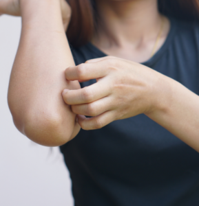 A woman suffering from eczema scratchers her arm.